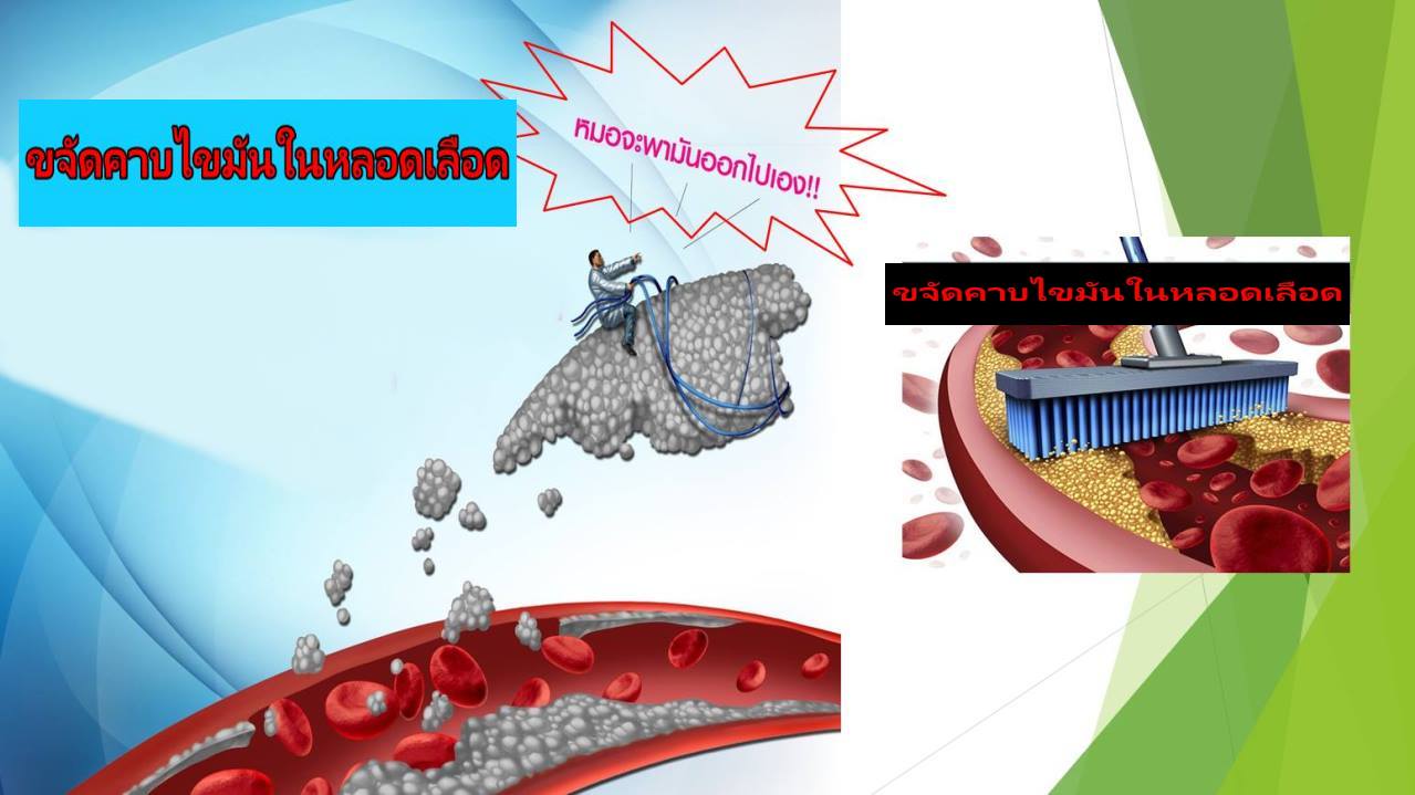 ล้างไขมันในหลอดเลือด (Vascular Therapies)